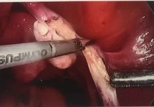 The normal right ovary and tube are removed.