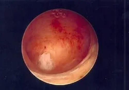 The normal uterine cavity after the fibroid is removed