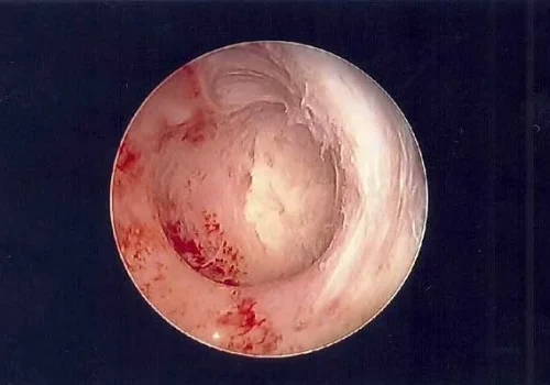 The normal uterine cavity at the end of the procedure