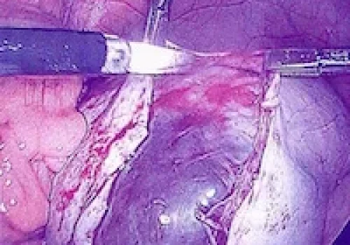 The outer tissue of the ovary is opened to find the cyst below. The cyst is removed and the normal left ovarian tissue remains