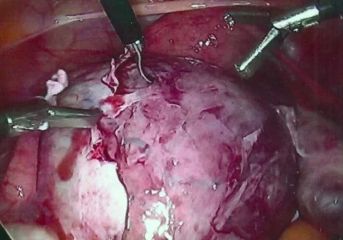 The ovarian cortex is incised to reveal the large cyst