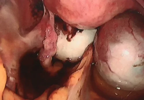 The ovarian endometrioma is 9cm and the left ovarian endometrioma is 5cm.