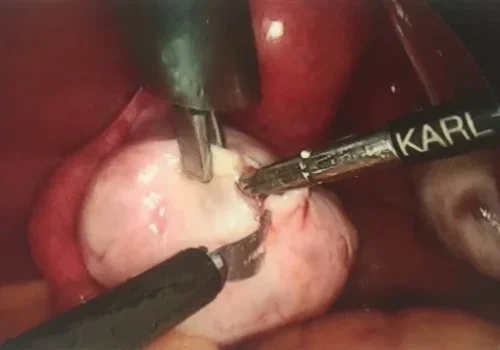 The ovarian tissue is carefully dissected to reveal the dermoid cyst.