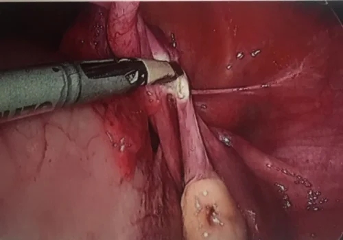 The ovaries were conserved at the patient's request. Normal right ovary seen. The ovarian ligament is divided.