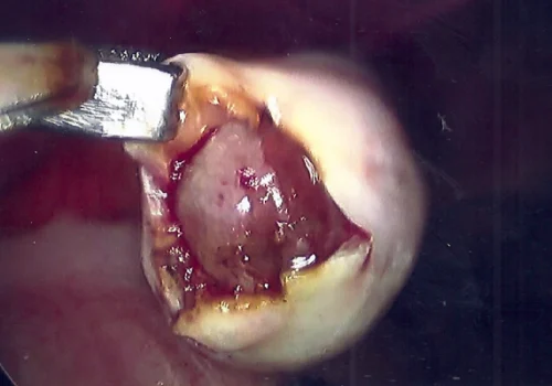 The ovary is opened and the cyst removed from the inside of the ovary