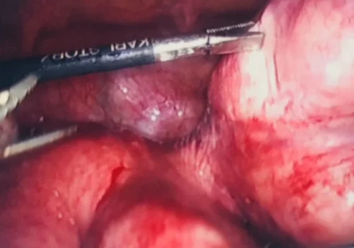 The pedunculated fibroid is attached to the body of the uterus via a stalk. It is likely that the stalk twisted and this caused the sudden onset of severe pelvic pain.