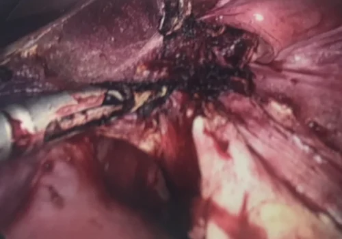 The pedunculated fibroid is removed - myomectomy. The stalk is bipolared and divided. This allows access to the uterus to perform the hysterectomy.