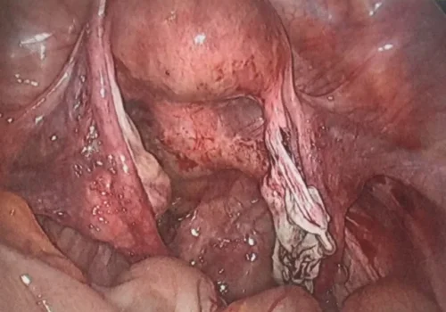 The pelvic at the end of the procedure. Ongoing re-modelling of the right ovarian tissue will occur over the next 4 weeks.