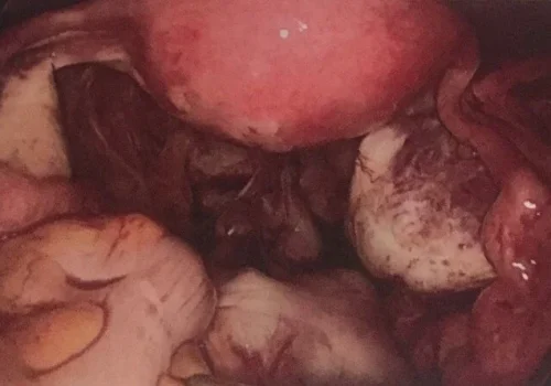 The pelvis at laparoscopy.