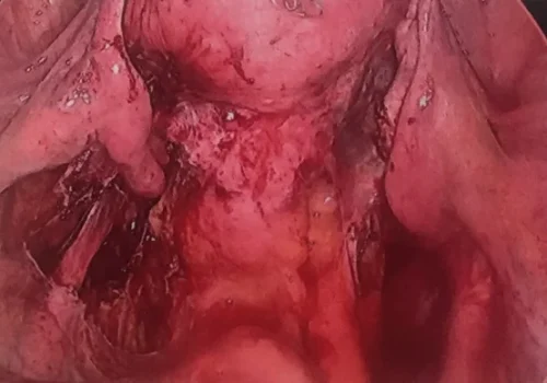 The pelvis at the completion of the laparoscopy demonstrating normal and mobile ovaries and patent tubes. All endometriosis has been excised.