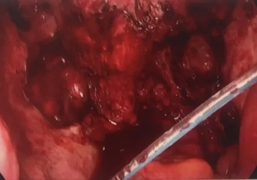 The pelvis at the completion of the procedure. A pelvic drain is removed the following day. Ongoing healing will occur and the inflammatory changes will resolve.
