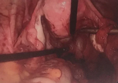 The pelvis at the end of the procedure..