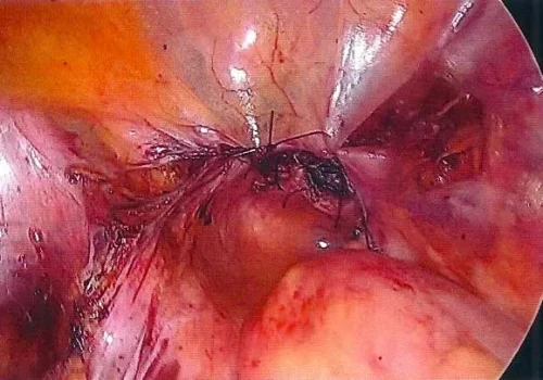 The pelvis at the end of the procedure