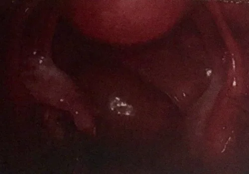 The pelvis at the end of the procedure.