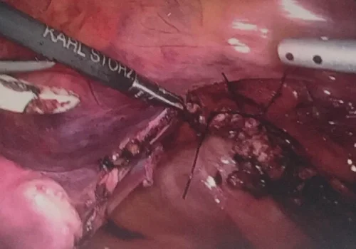 The pelvis at the end of the procedure - showing vaginal vault sutures.