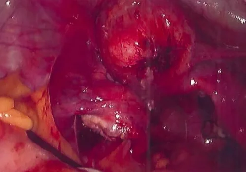 The pelvis at the end of the procedure. Both ovaries are now mobile and all endometriosis has been excised