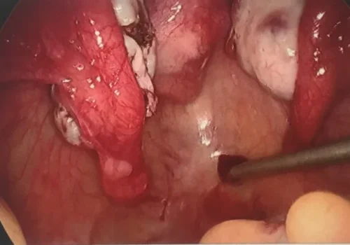 The pelvis at the end of the procedure. Ongoing remodelling of the left ovary will continue over the next few weeks.
