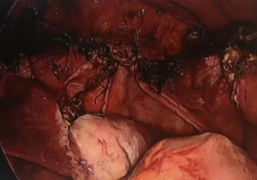 The pelvis at the end of the procedure. The vagina has been laparoscopically sutured. The normal left ovary is seen in this image.