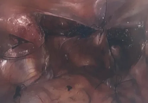 The pelvis at the end - the peritoneum is closed over the sling to minimise scarring.