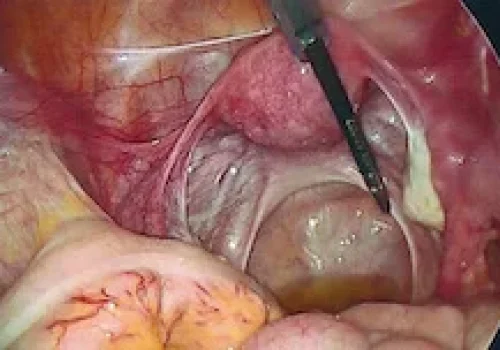 The pelvis is now normal