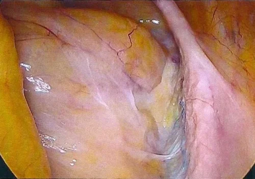 The peritoneum has grown over the mesh and it is barely seen..