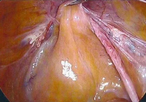 The peritoneum has grown over the mesh and it is barely seen...