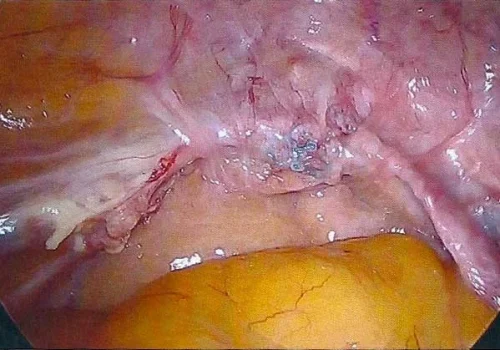 The peritoneum has grown over the mesh and it is barely seen.