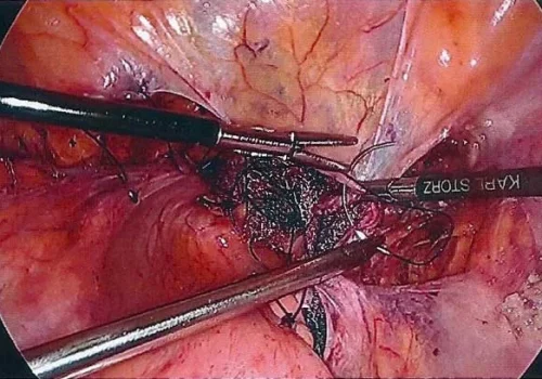 The peritoneum is closed over the mesh