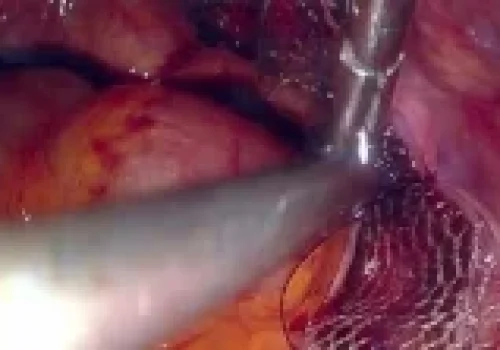 The peritoneum is closed over the mesh