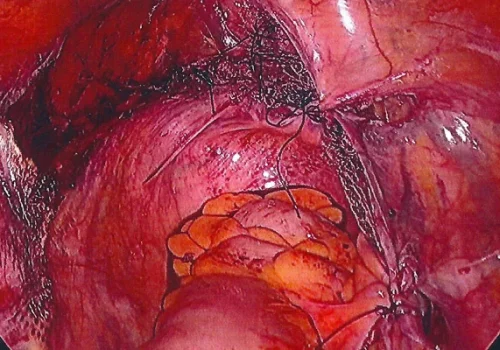 The peritoneum is closed over the top of the mesh. At the end of the procedure.