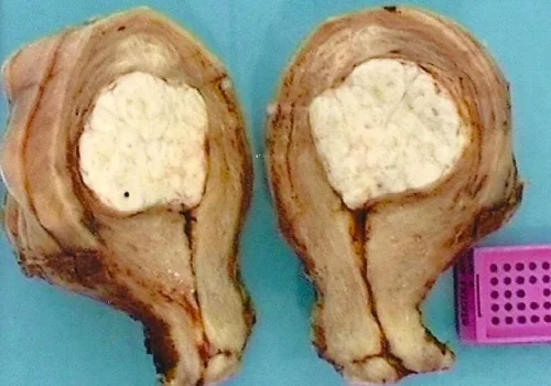 The pictures of the uterus and cervix showing a large fibroid which had grown into the cavity.