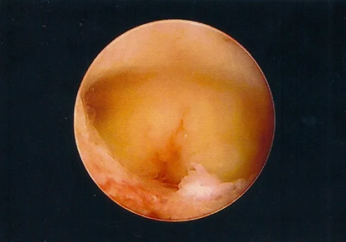 The polyps have been resected. View of a normal uterine cavity