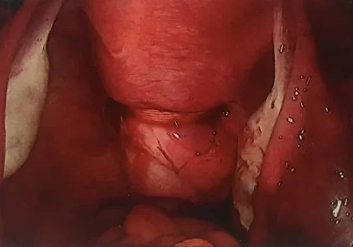The position of the cerclage at the back of the cervix.