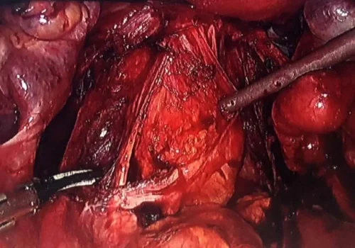 The rectum has been dissected from posterior cervix by sharp dissection. Endometriosis over the surface of the rectum and para-rectal fossae has been excised.