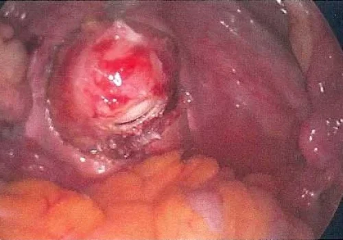 The rectum has been liberated and affected area of the wall excised.