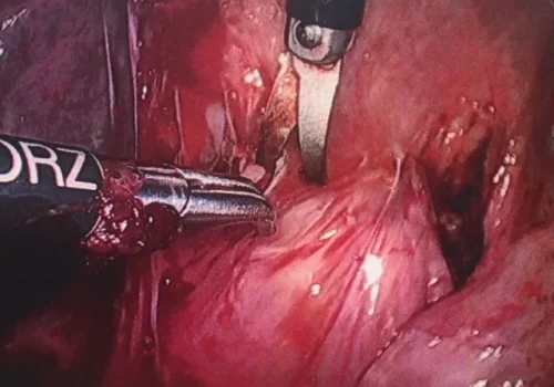 The rectum is carefully liberated from the posterior cervix and underlying endometriosis is excised