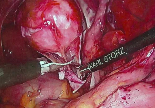 The rectum is dissected clear of the vaginal vault – for later attachment of the mesh