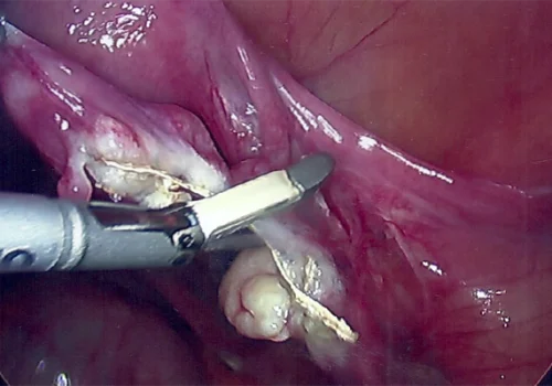 The right Fallopian Tube is removed. The right ovary can be seen just below