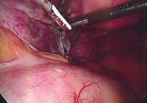 The right Uterine Artery pedicle is divided.