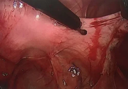 The right Utero-sacral ligament endometriosis is excised.