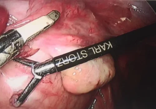 The right broad ligament pedicle is divided. The right ovary is preserved.