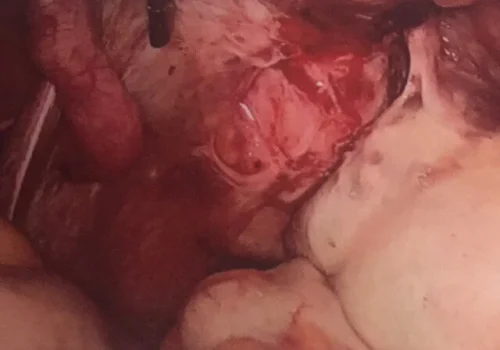 The right ovarian dermoid cyst. There is evidence of endometriosis over the left side wall and the left ovary is adherent.