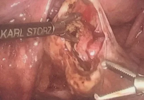 The right ovarian endometrioma is removed - and normal ovarian tissue is preserved.