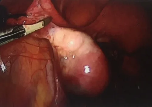 The right ovarian ligament is divided and the right ovary is preserved .