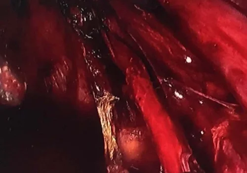 The right ovary has been mobilised and the endometrioma wall excised. The right ureter has been dissected out and endometriosis on right side wall excised