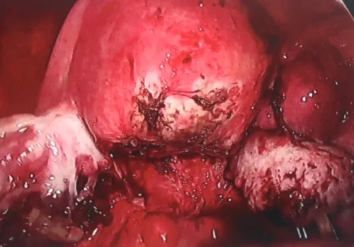 The right ovary has been mobilised. All endometriosis from side walls has been excised. This demonstrates the normal pelvis at the end of the operation