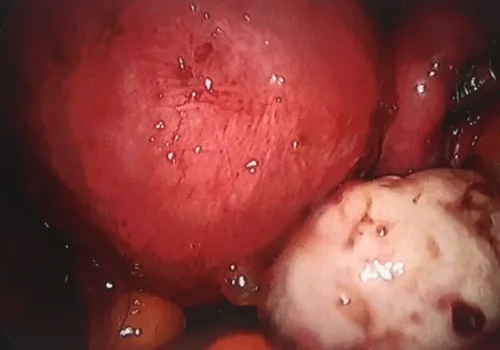 The right ovary is adherent to the uterus and right side wall. There is significant adenomyosis (enlarged, inflamed uterus). The bowel is adherent to the posterior cervix and uterus.