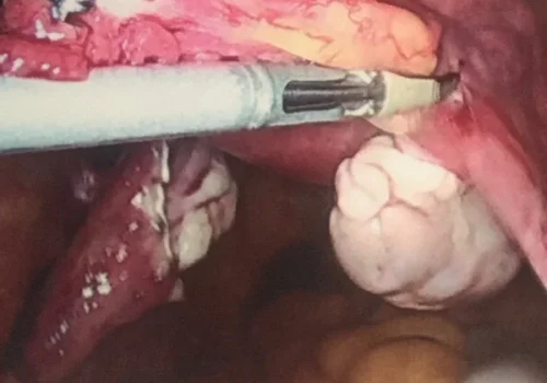 The right ovary is conserved.