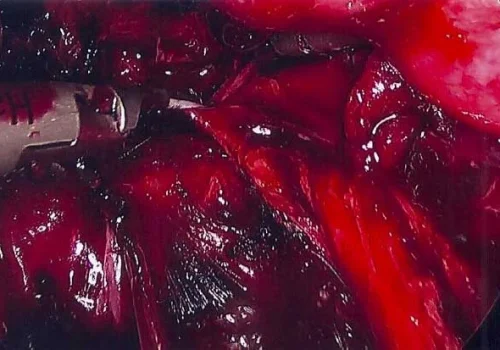 The right ovary is liberated from the pelvic side wall. The right ureter has been dissected out.