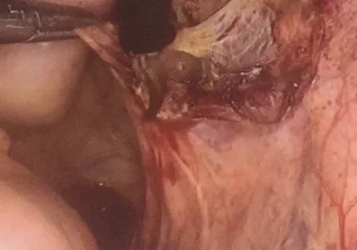 The right pelvic side wall endometriosis is excised.